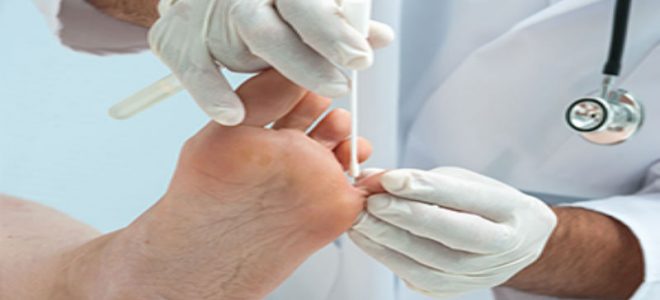 Banish Toe Fungus in Plainfield and Get the Healthy Feet You Deserve