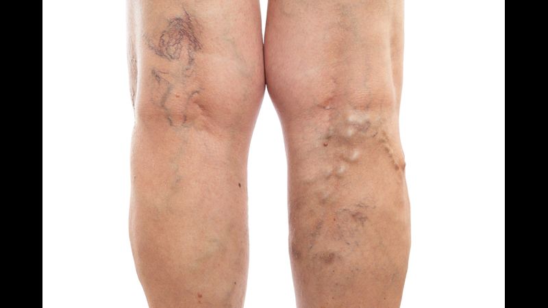 What You Need to Know About Spider Vein Treatment in Mercer County, NJ