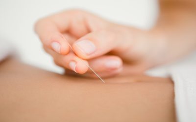 Achieve better stress management with acupuncture sessions in Sudden Valley, WA, designed for your health goals.